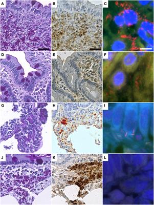 Fluorescence In Situ Hybridization for Diagnosis of Whipple’s Disease in Formalin-Fixed Paraffin-Embedded Tissue